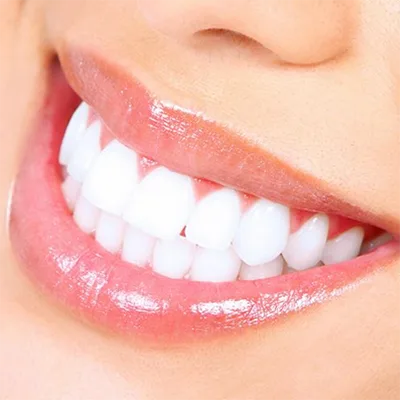 Teeth Whitening