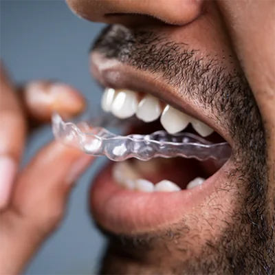 Invisalign